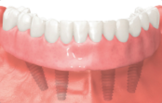 conventional dentures