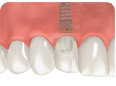 Dental Implant With a Crown